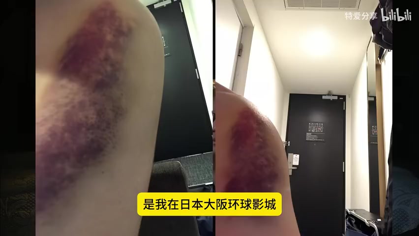 手臂上发黑的淤青特写